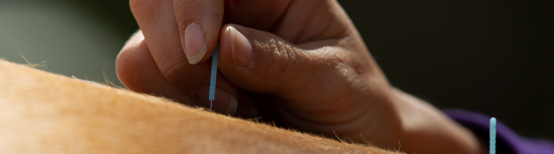 acupuncture