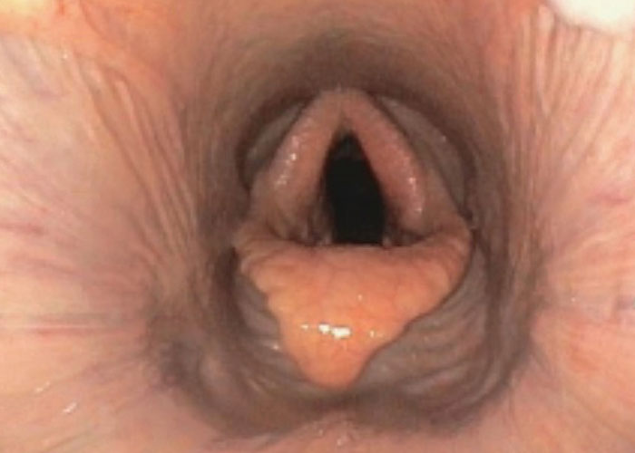 Upper airway endoscopy showing purulent drainage from the left guttural pouch