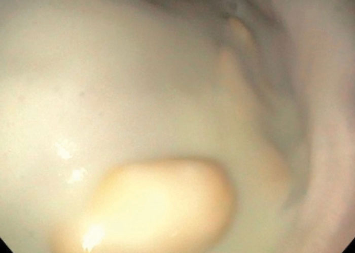 Guttural pouch endoscopy showing chondroids within purulent discharge